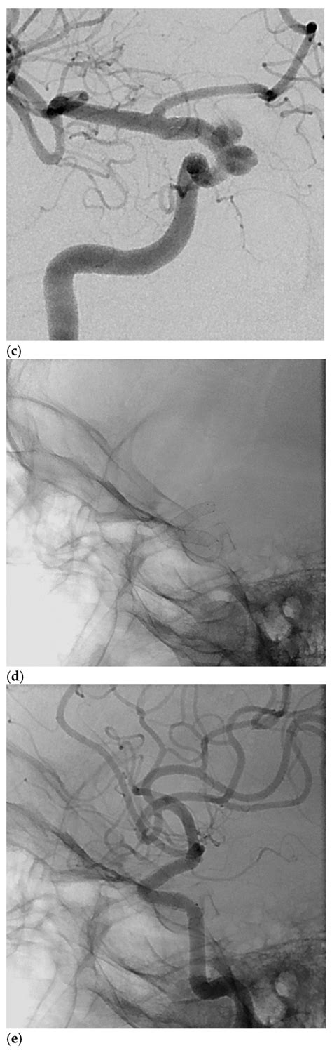 Derivo Embolization Device for the Treatment of Intracranial Aneurysms.